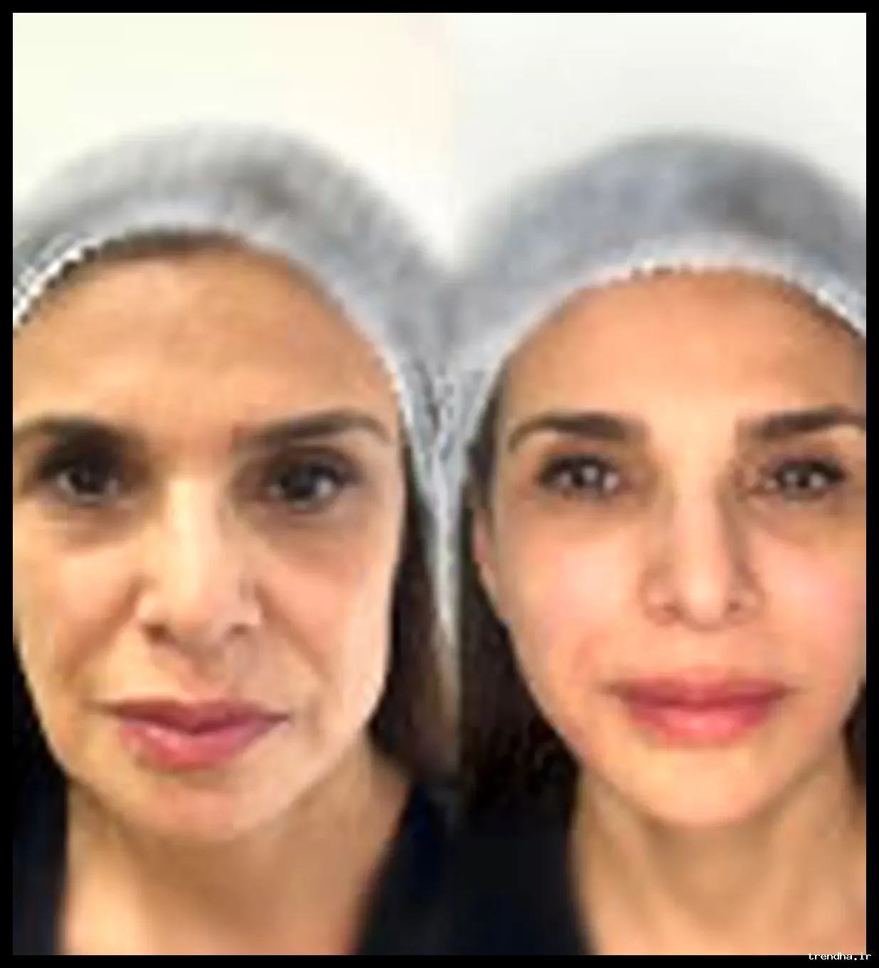 مقایسه روش‌های لیفت با نخ و اندولیفت: کدام یک بهتر است؟